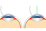 Lasik - laser vision correction provided by Skippack Eyecare optometrists