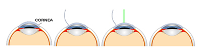 Lasik - laser vision correction provided by Skippack Eyecare optometrists